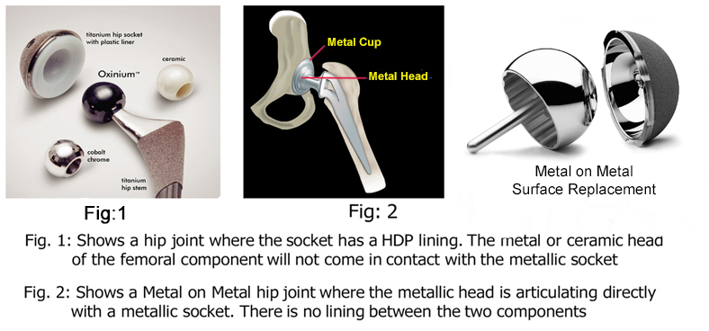 'Metal-on-metal' Hip Implant Patients Recalled for Tests
